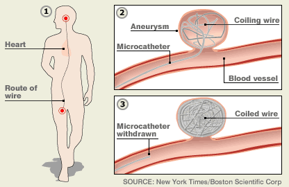 Brain Aneurysm Coiling